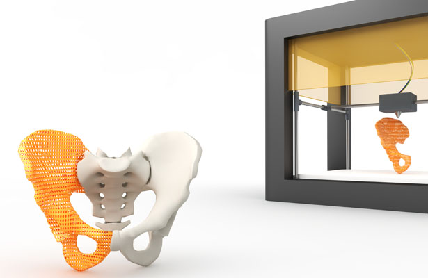 3D printed hip